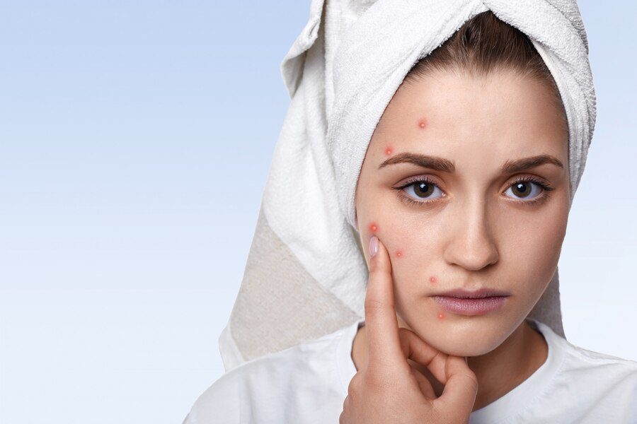 Oily and Acne-Prone Skin